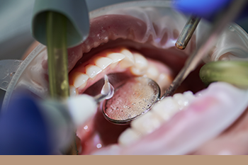 BClinic - Dental Clinic - Services - الكشف المبدئي لسرطانات الفم