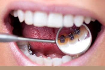 BClinic - Dental Clinic - Services - Incognito Lingual Braces